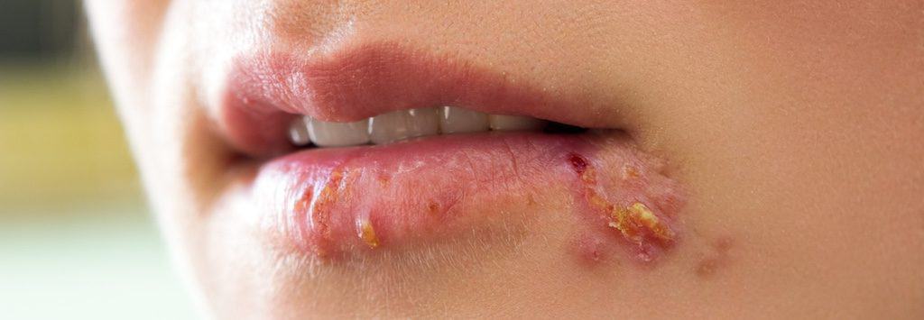 Hautprobleme Mundwinkel Herpes schöne Zähne Haut Lippen
