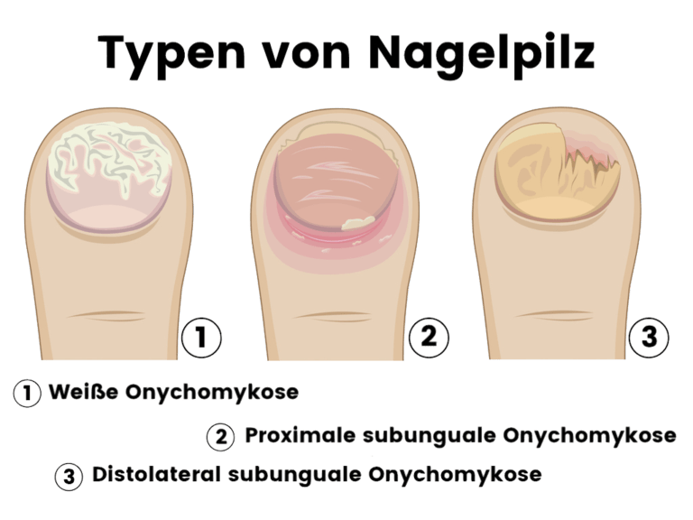 Nagelpilz Wie Bekommt Man Ihn Und Was Kann Man Dagegen Tun