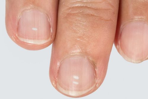 weiße flecken nagel finger